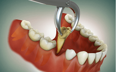 Dental forceps removing a tooth