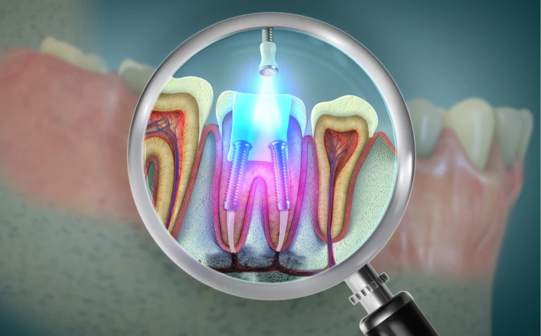Dental root canal procedure illustration