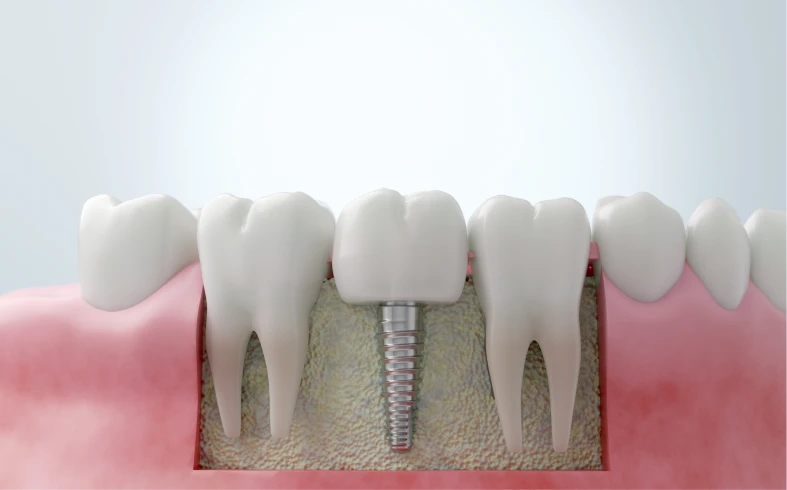 Dental implant between natural teeth