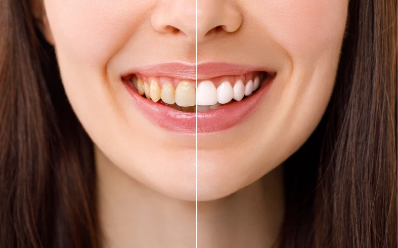 Teeth before and after whitening comparison